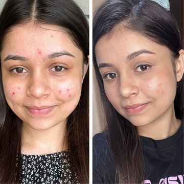 Plix acne spot corrector gel - reduce ance in just 3 days